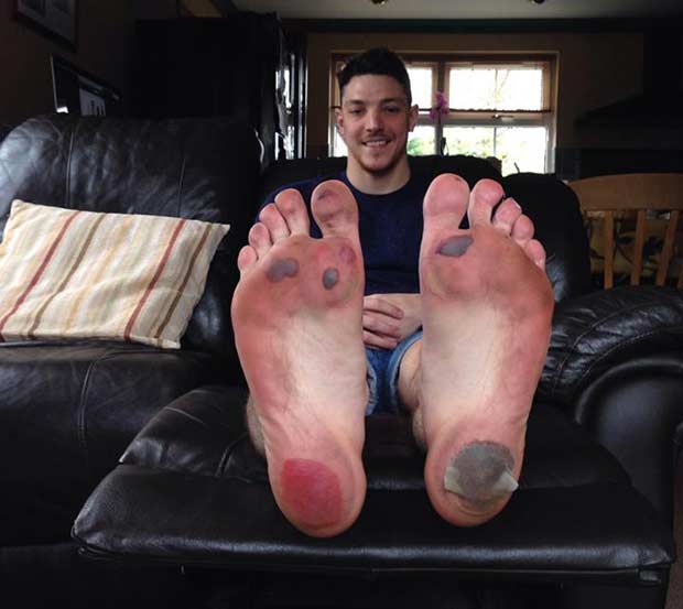 Chris' injured feet after his barefoot charity run.