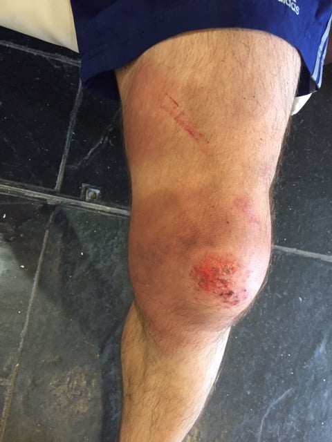 Ross' swollen knee after crashing on the course.